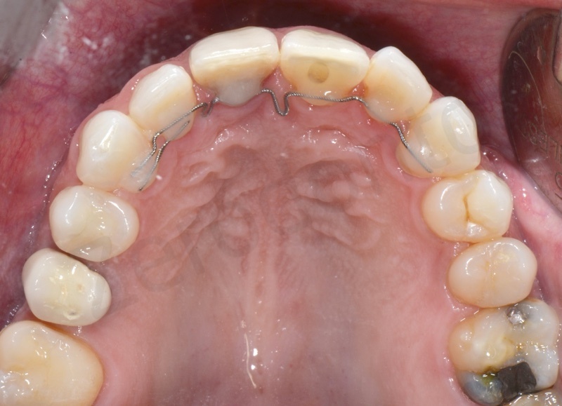 ortodonzia linguale senza attacchi, arcata superiore