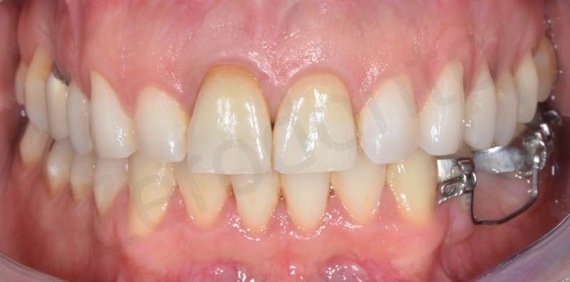 ortodonzia linguale senza attacchi